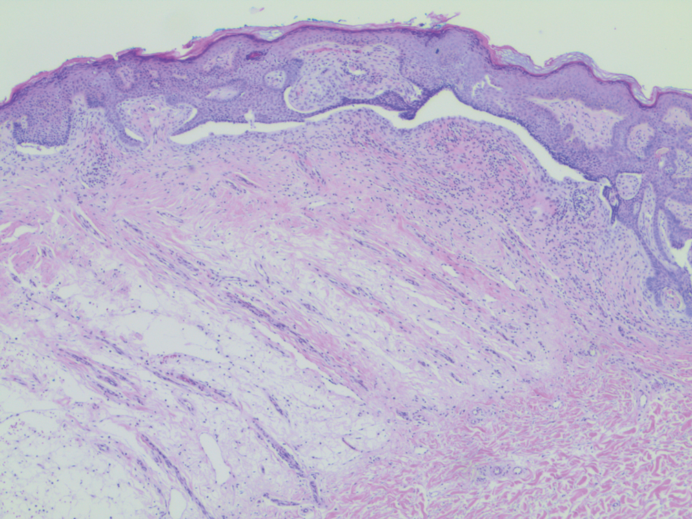 basal cell carcinoma